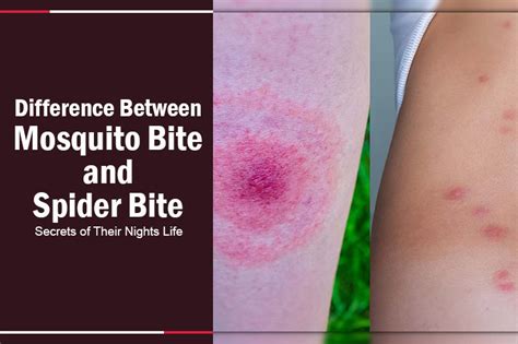 1. Ultimate Guide: Spider Bite Vs Mosquito, The Truth