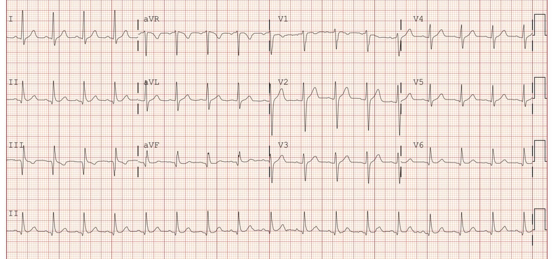 10+ Borderline Ecg Patterns: Essential Insights And Interpretations