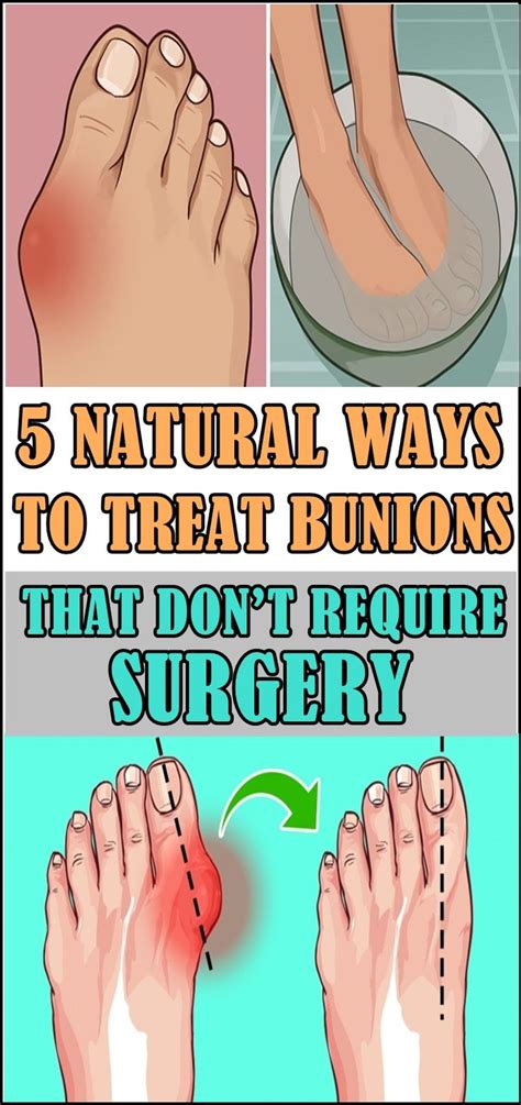 10 Natural Ways To Treat Your Bunions At Home How To Treat Bunions