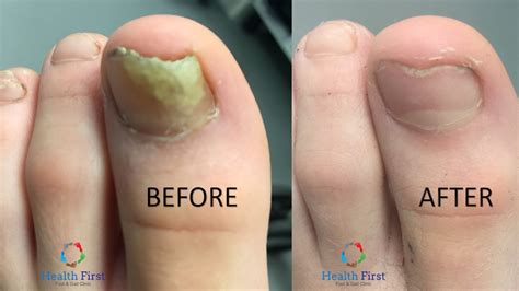 142 Best Nail Fungus Treatment Images Fungi Toe Nails Toenails