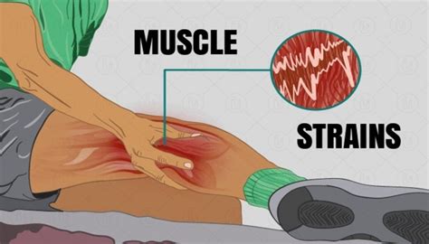 17+ Expert Tips For Treating And Preventing Leg Muscle Tears: Your Comprehensive Resource