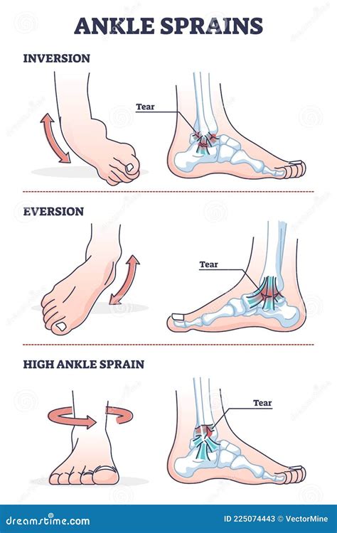 3. Inversion Techniques: Essential Facts For Injury Prevention