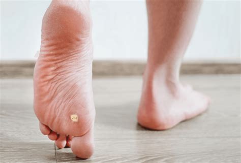 5 Expert Tips To Spread Warts Today