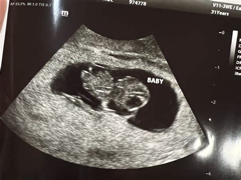 8 Week Ultrasound Photo