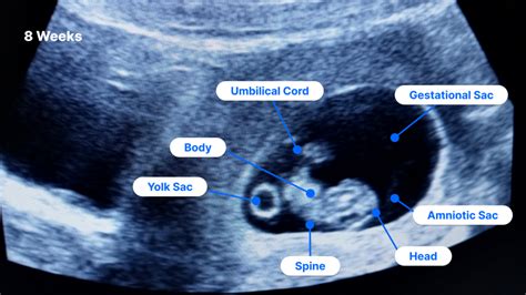 8 Week Ultrasound Pictures Fetus Size Twins And More