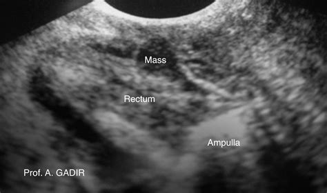 Above 3 Images Show Longitudinal View Of A Normal Looking Tubular