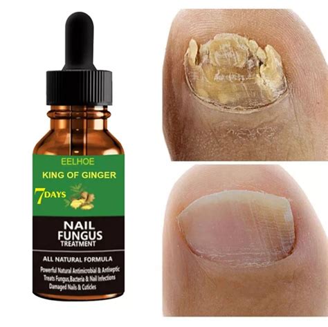 Acrylic Nail Fungus Causes And Treatment Toenail Fungus Remedies