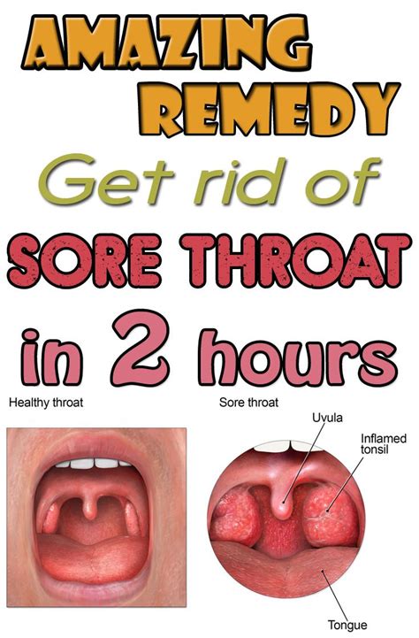 Amazing Remedy Get Rid Of Sore Throat In 2 Hours Throat Remedies