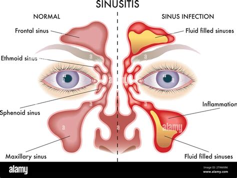 Anatomy Of Sinus Infection