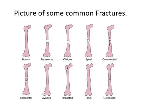 Anatomy Quiz Types Of Fractures Anatomy Of The Long Bone Functions