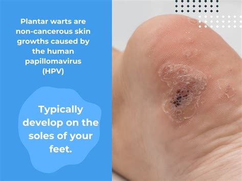 Are Plantar Warts Contagious