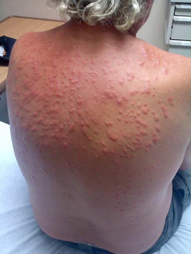 Bed Bugs Rash Treatment