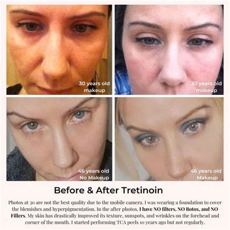 Before And After Retin A Skin Tips Skin Care Tips Tretinoin Anti Wrinkle Cream Face Skin