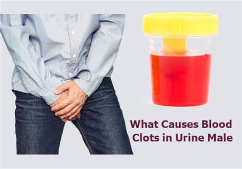 Blood Clots Urine Men