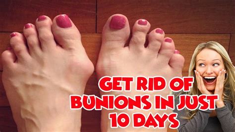 Bunions Ease Your Bunions In Just 10 Days With This Powerful Home