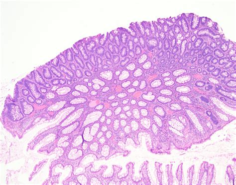 Colon Polyp Histology