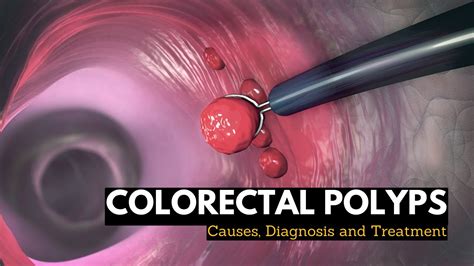 Colon Polyps Causes Symptoms Diagnosis And Treatment