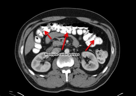 Colon Polyps Ct Scan Wikidoc