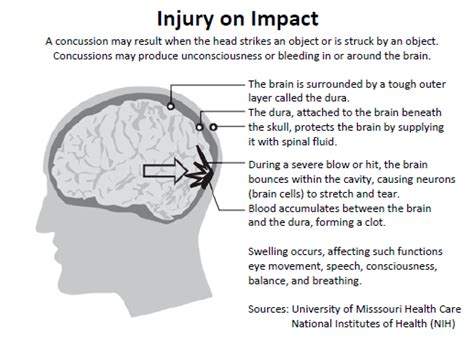 Concussion Movie Medical Facts