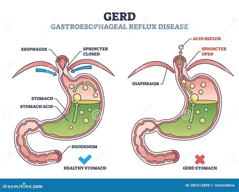 Diagram Diagram Of Gerd Pain Mydiagram Online