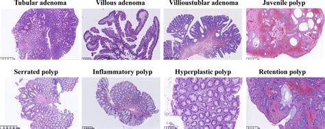 Different Types Of Colon Polyps