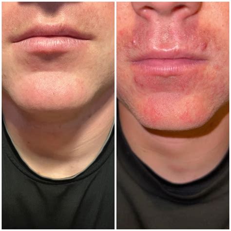 Doxycycline For Perioral Dermatitis