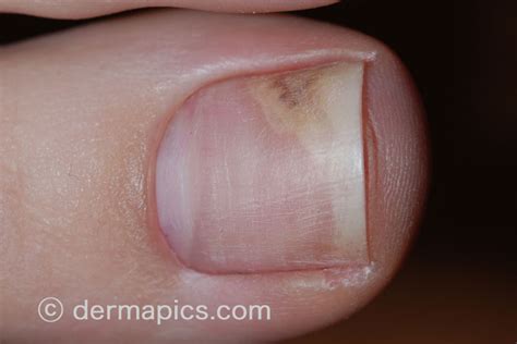 Fingernail Fungus Causes Treatment Nail Ftempo