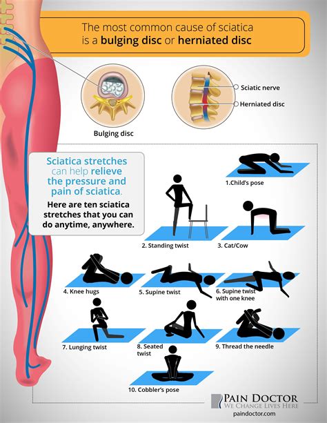 Five Simple Strategies To Alleviate Sciatic Nerve Pain Taught By A