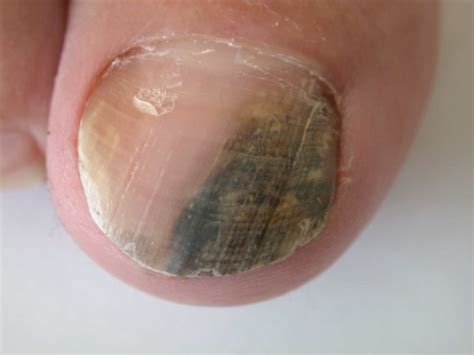 Fungal Infection Of The Nail Caused By Fusarium Sp Cau Open I