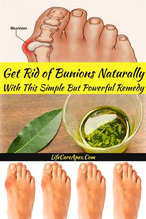 Get Rid Of Bunions Naturally With This Simple But Powerful Remedy Get