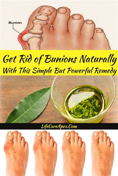 Get Rid Of Bunions Naturally With This Simple But Powerful Remedy