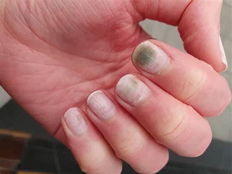 Green Fungus Under Acrylic Nail Treatment Explainer Why Do We Get