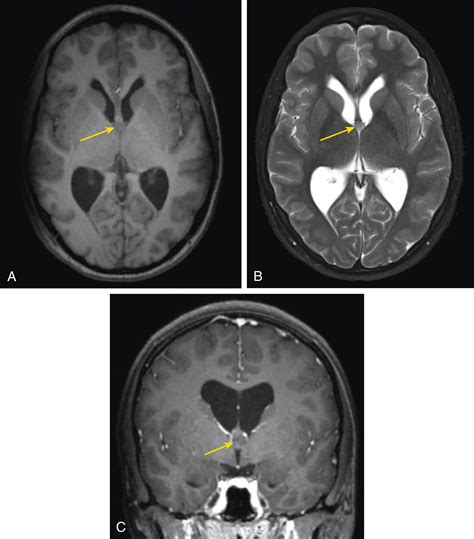 Headache Blurry Vision And Intraventricular Mass Clinical Tree