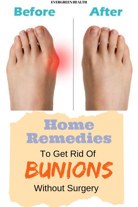 Home Remedies To Get Rid Of Bunions Without Surgery Get Rid Of