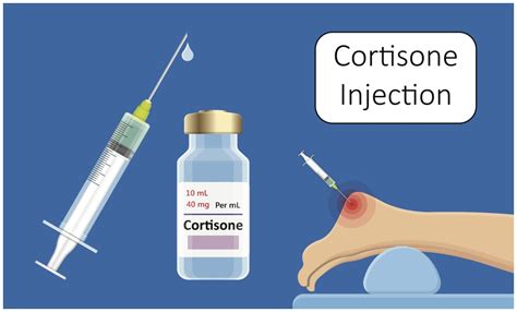 How Long Does It Take For A Cortisone Shot To Work Sport Doctor London