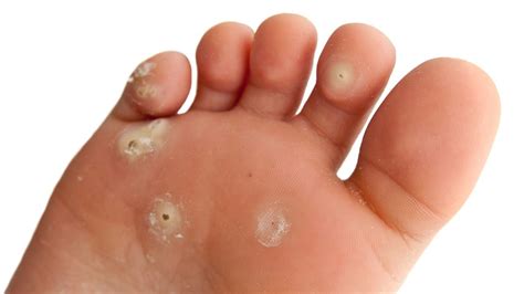 How Plantar Warts Spread Blog