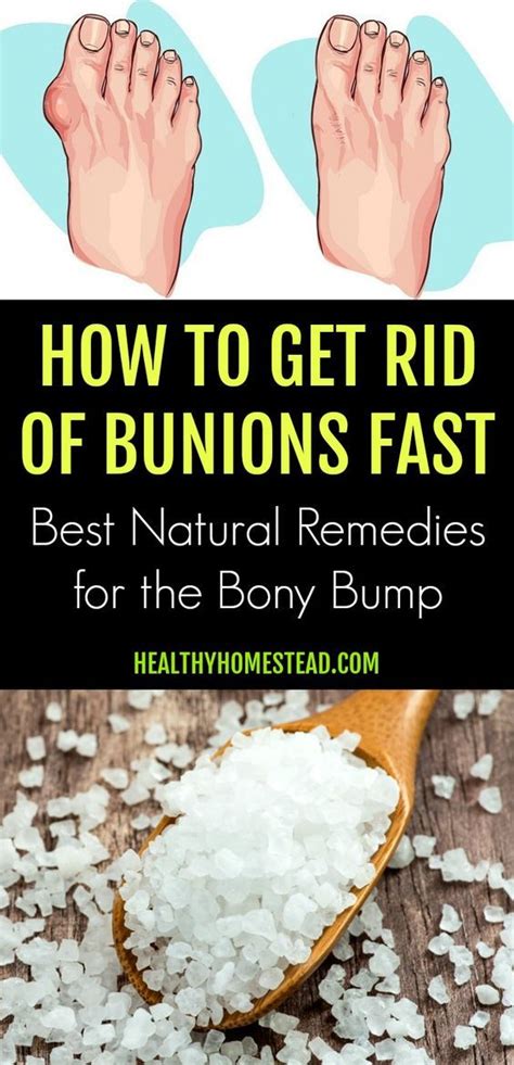 How To Get Rid Of Bunions Fast Best Natural Remedies For The Bony