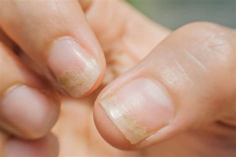 How To Treat Nail Fungus Under Acrylic Nailsnail Fungus Cured With