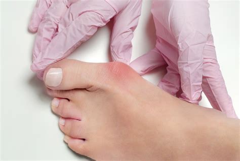 How To Treat The Bursitis Of A Bunion Effective Remedies