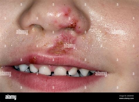 Impetigo Rash On Face Strep Throat Impetigo