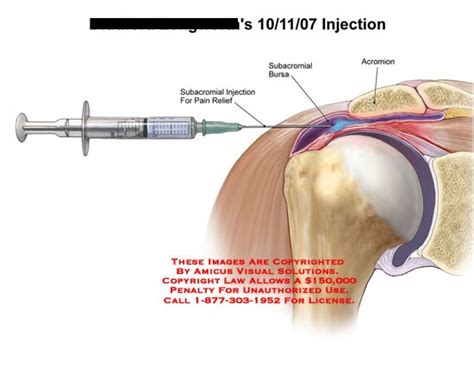 Injections For Shoulder Impingement Steroid Injections For Shoulder