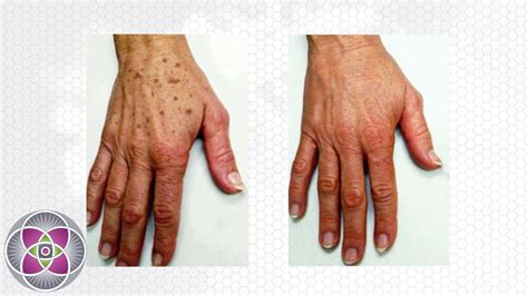 Laser Hand Rejuvenation Eliminates Age Spots Liver Spots Youtube