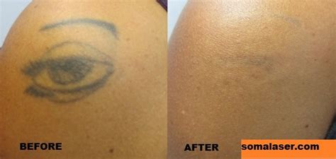 Laser Tattoo Removal Before And After Somalaser