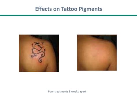 Laser Tattoo Removal In Flemington Nj Advanced Medical Spa