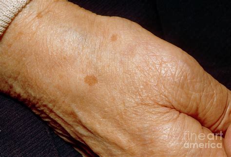 Liver Spots On Hands Images