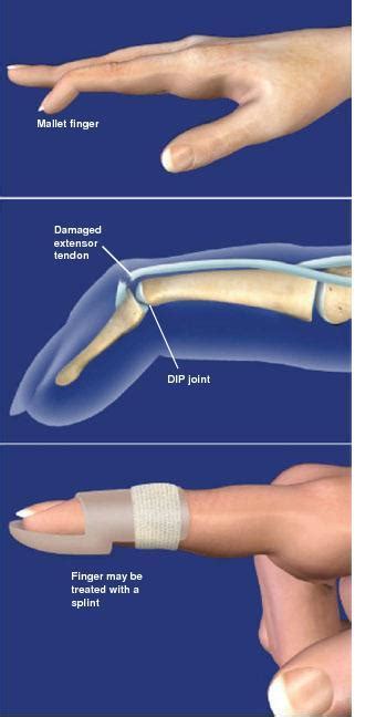 Mallet Finger A Painless Discomfort