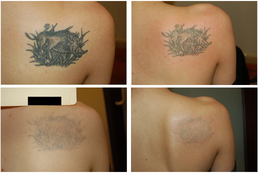 More Amazing Laser Tattoo Removal Before And After Photos From Well