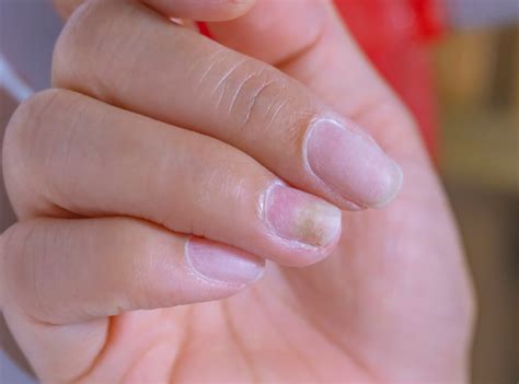 Nail Fungus Under Acrylic Nail