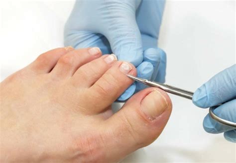 Navigating Toenail Trauma Types Treatment And Prevention Centers