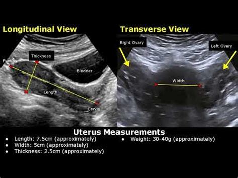 Normal Uterus Measurements Ultrasound